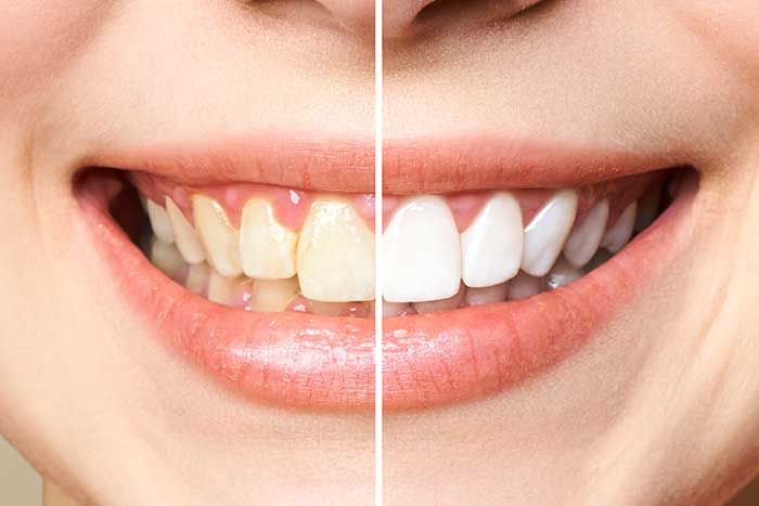 imagem clareamento dental