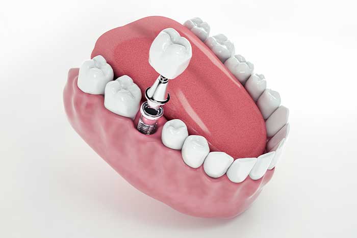imagem implante dentário