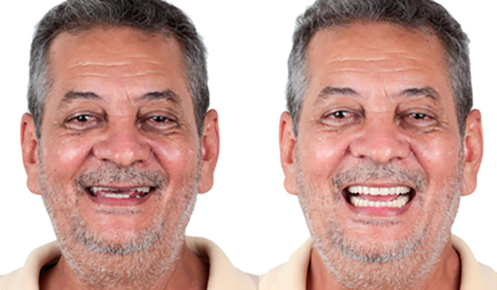 imagem de implantes